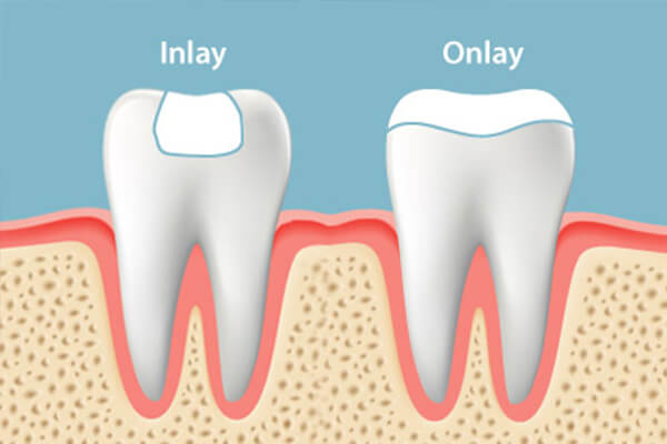 Dental Fillings, Inlays Onlays